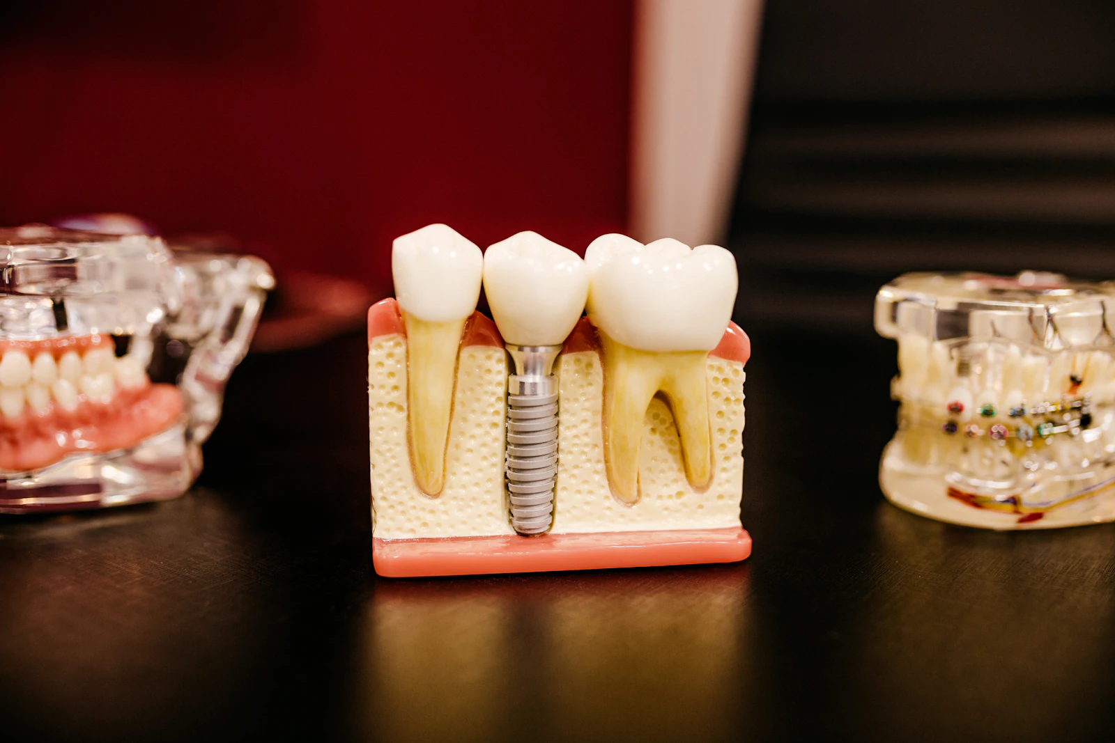 Prothèses et implants dentaires